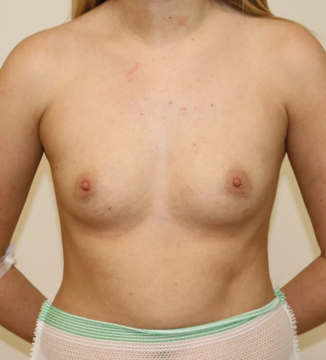 Breast enlargement before surgery AP view