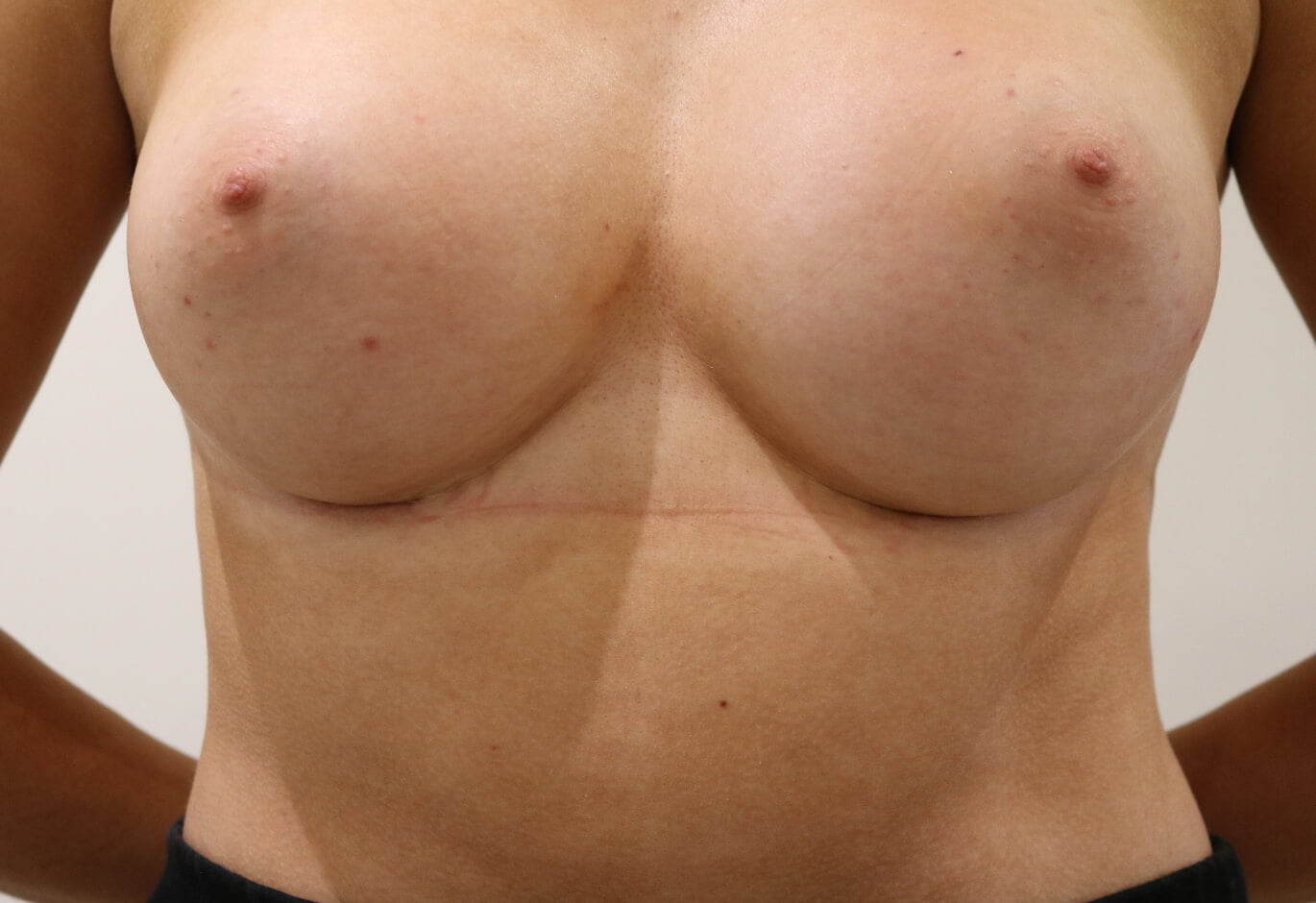 Breast enlargement close up of inframammary fold scars