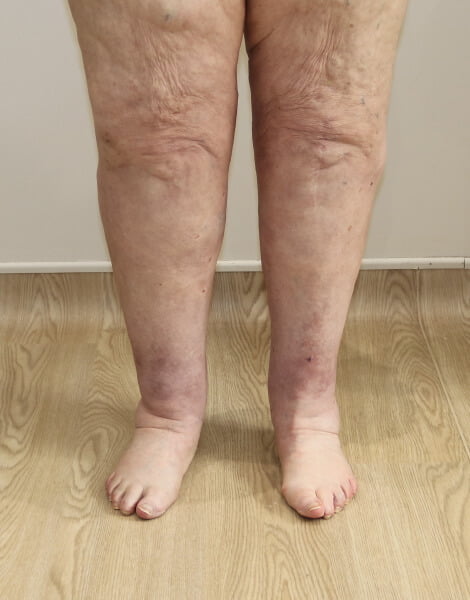 Lower limb lipoedema liposuction AP view after surgery