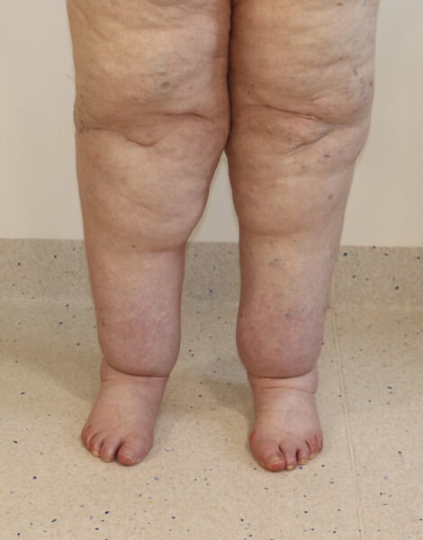 Lower limb lipoedema liposuction AP view before surgery
