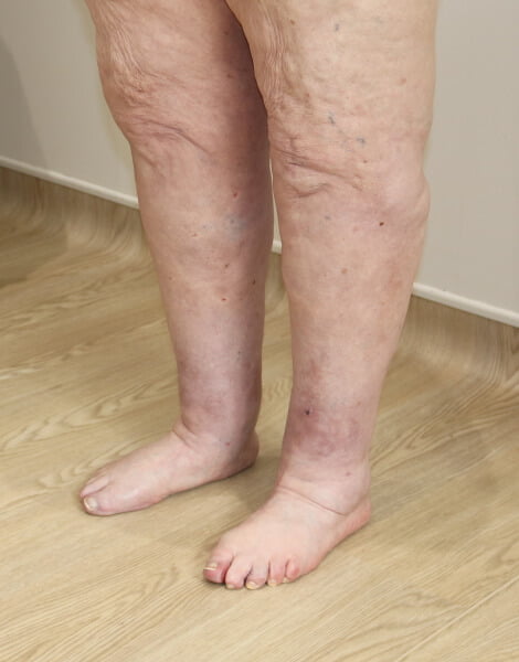 Lower limb lipoedema liposuction left oblique view after surgery