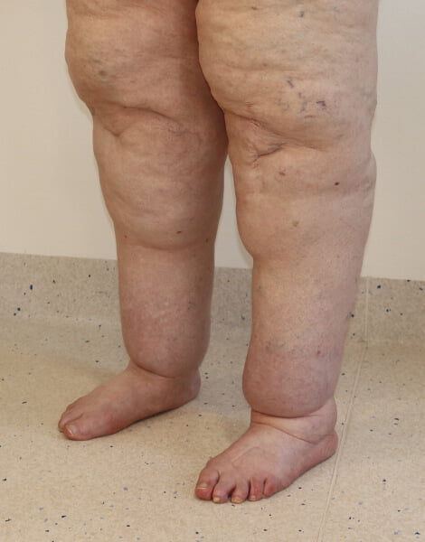 Lower limb lipoedema liposuction left oblique view before surgery