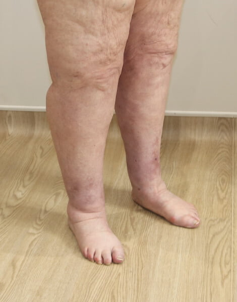 Lower limb lipoedema liposuction right oblique view after surgery