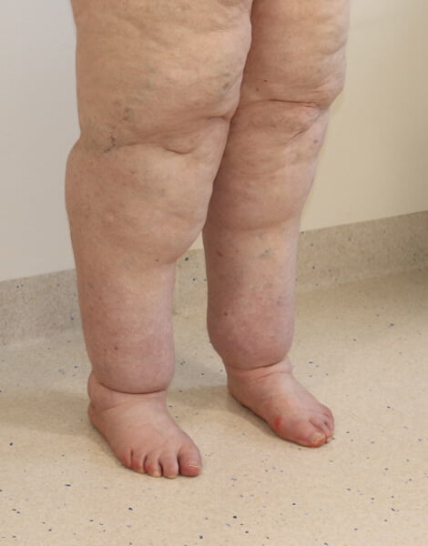 Lower limb lipoedema liposuction right oblique view before surgery