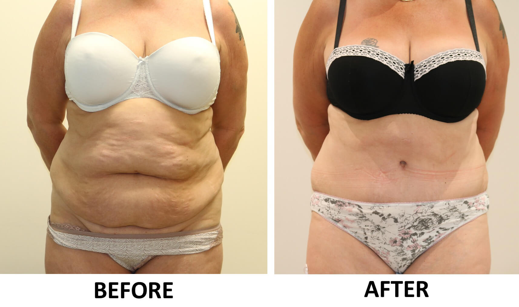 Brazilian tummy tuck before and after photos AP view