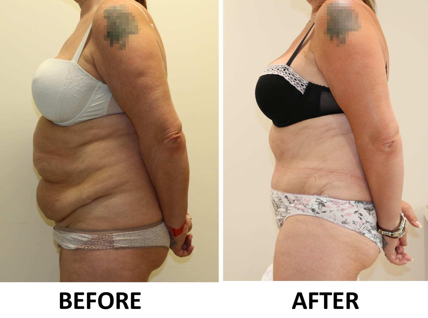 Brazilian tummy tuck before and after photos left lateral view