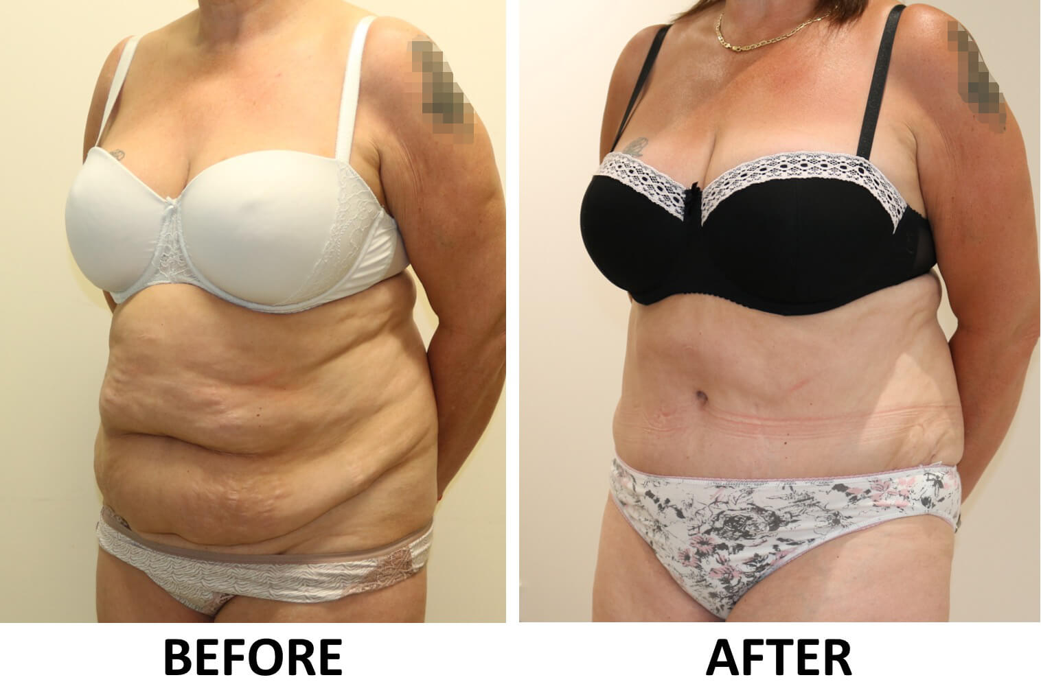 Brazilian tummy tuck before and after photos left oblique view