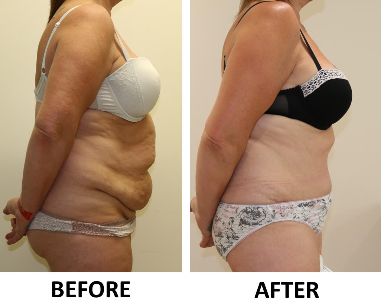 Brazilian tummy tuck before and after photos right lateral view