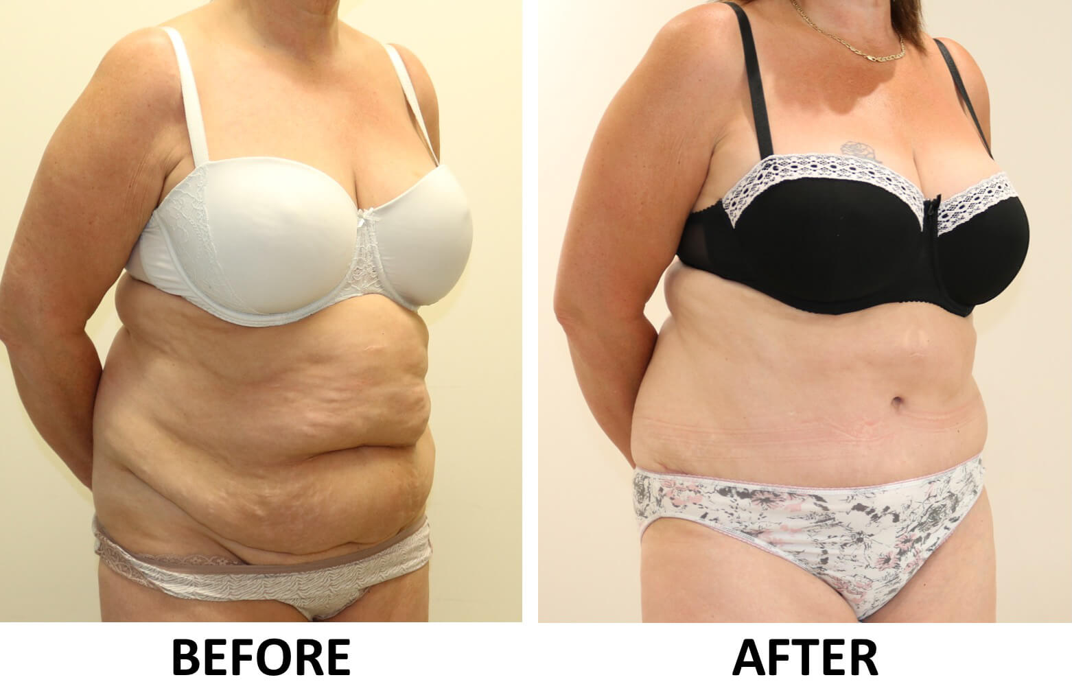 Brazilian tummy tuck before and after photos right oblique view