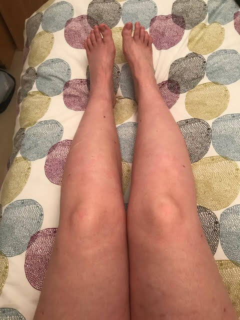 After lipoedema liposuction surgery 