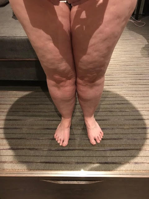Before lipoedema liposuction surgery 