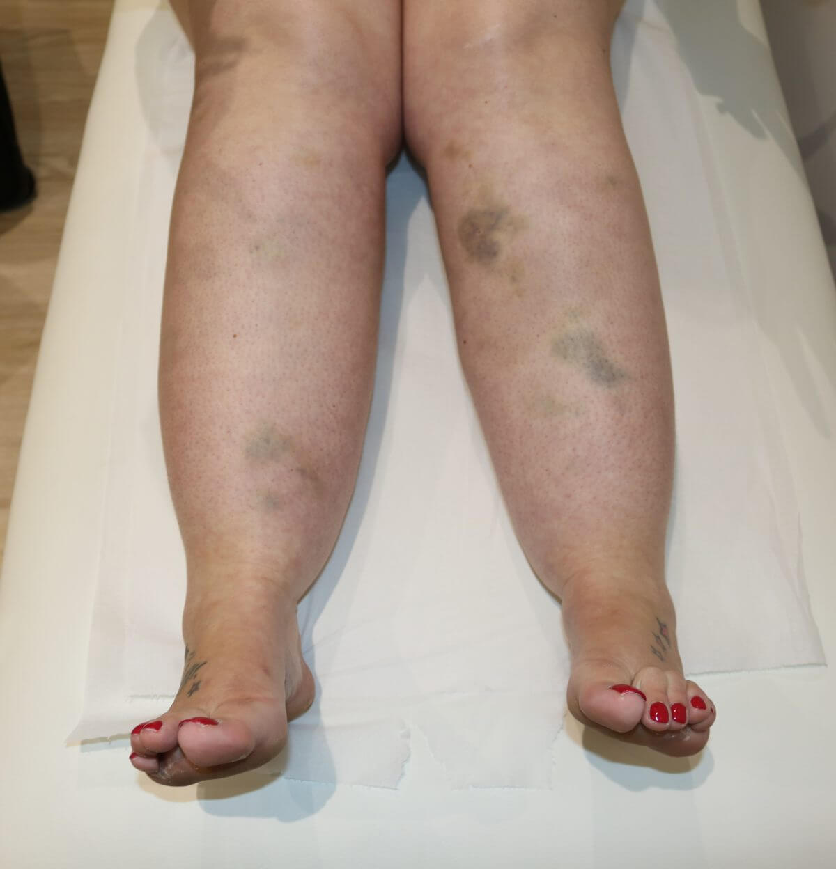 Lipoedema bruising 1 1200 x 1248 2