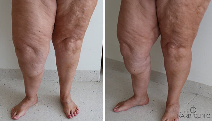 Lipoedema_The-Karri-Clinic_2