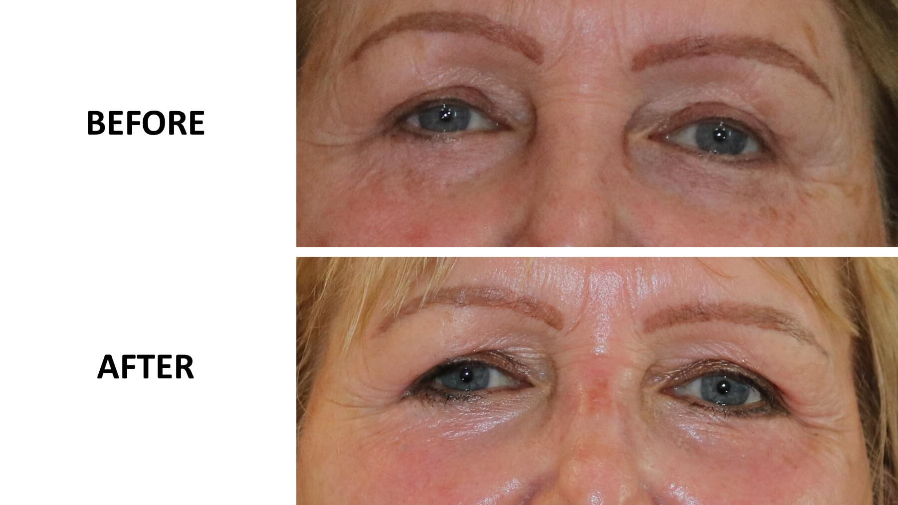 Lower eyelid phenol peel before and after