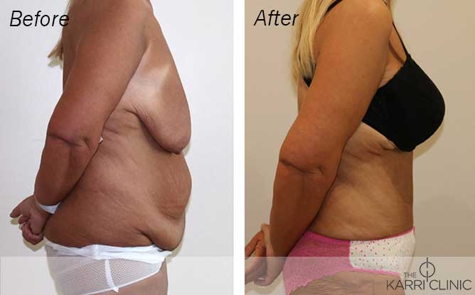 Mummy Makeover The Karri Clinic