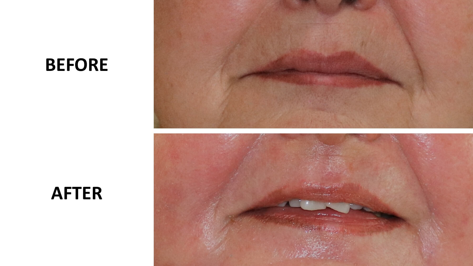 Perioral phenol peel before and after