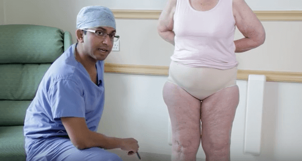 Lipoedema Liposuction