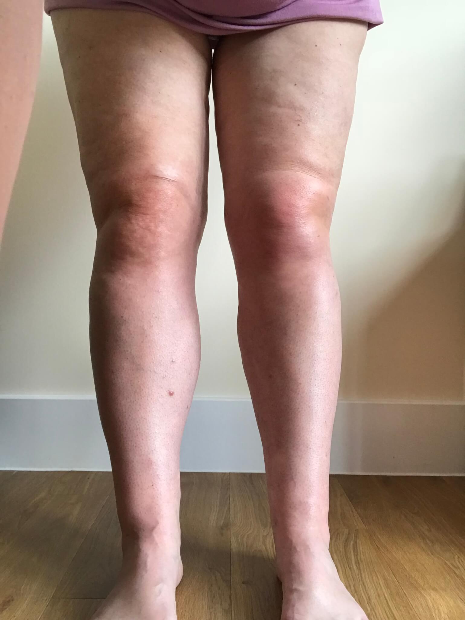 Beth's legs after surgery