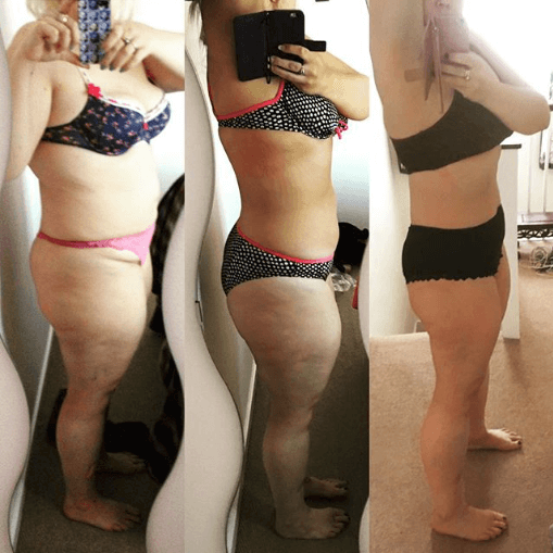 Karen Windsor - Lipoedema Story