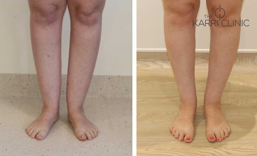 Cankles 1
