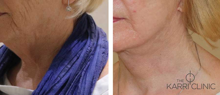 Facelift phenol peel 2