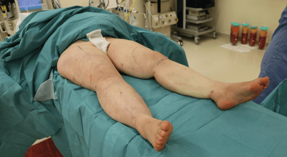 Lipoedema surgery