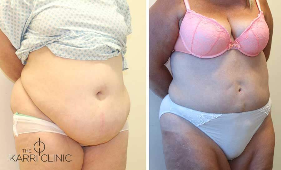 Tummy Tuck 2