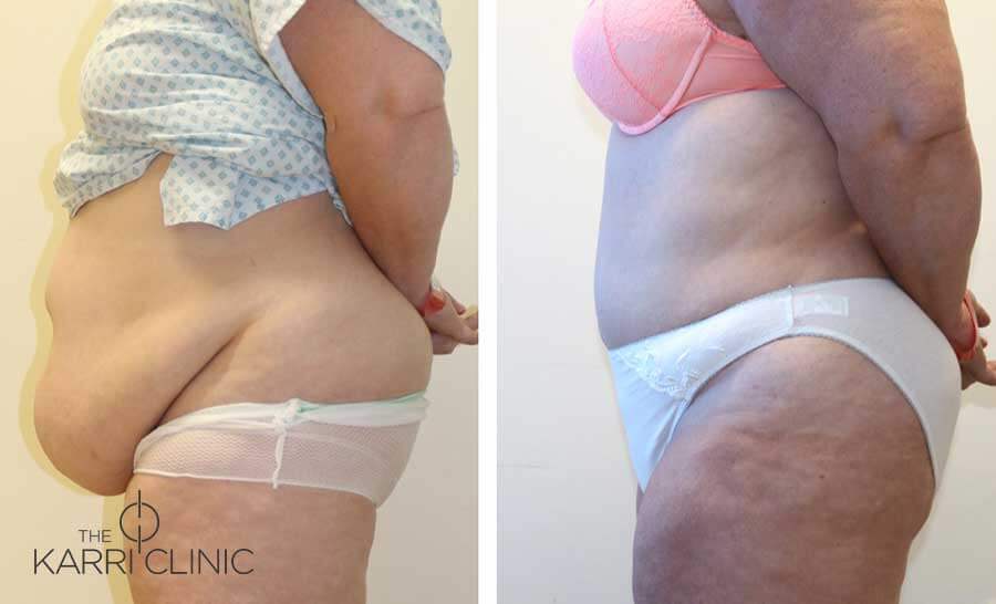 Tummy Tuck 3