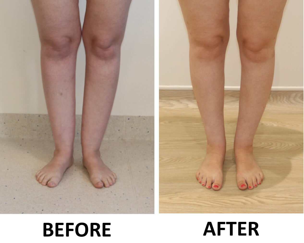 Ankle sculpting 1