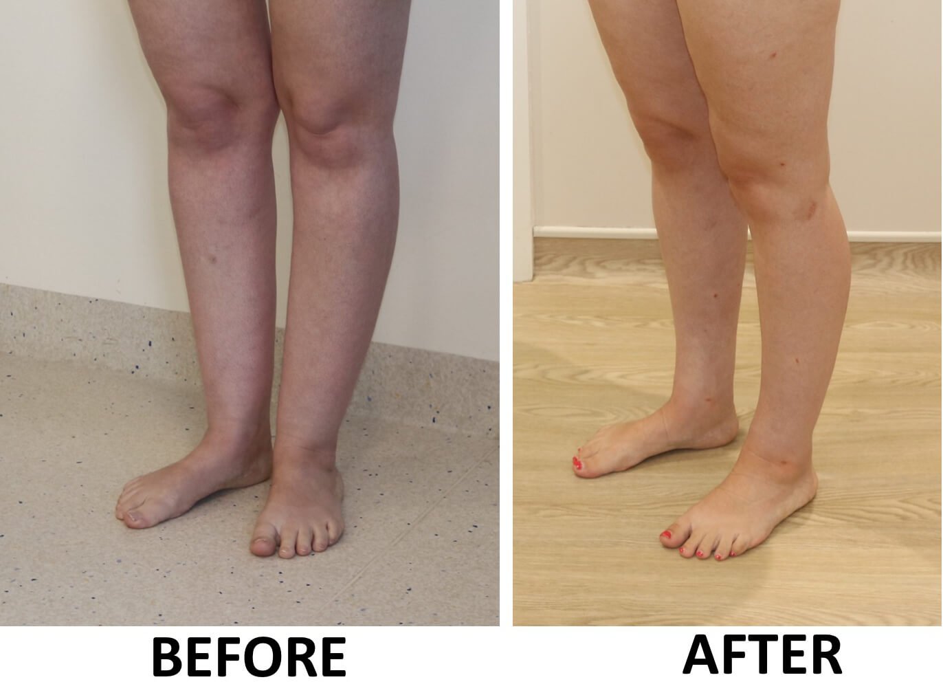 Ankle sculpting 2