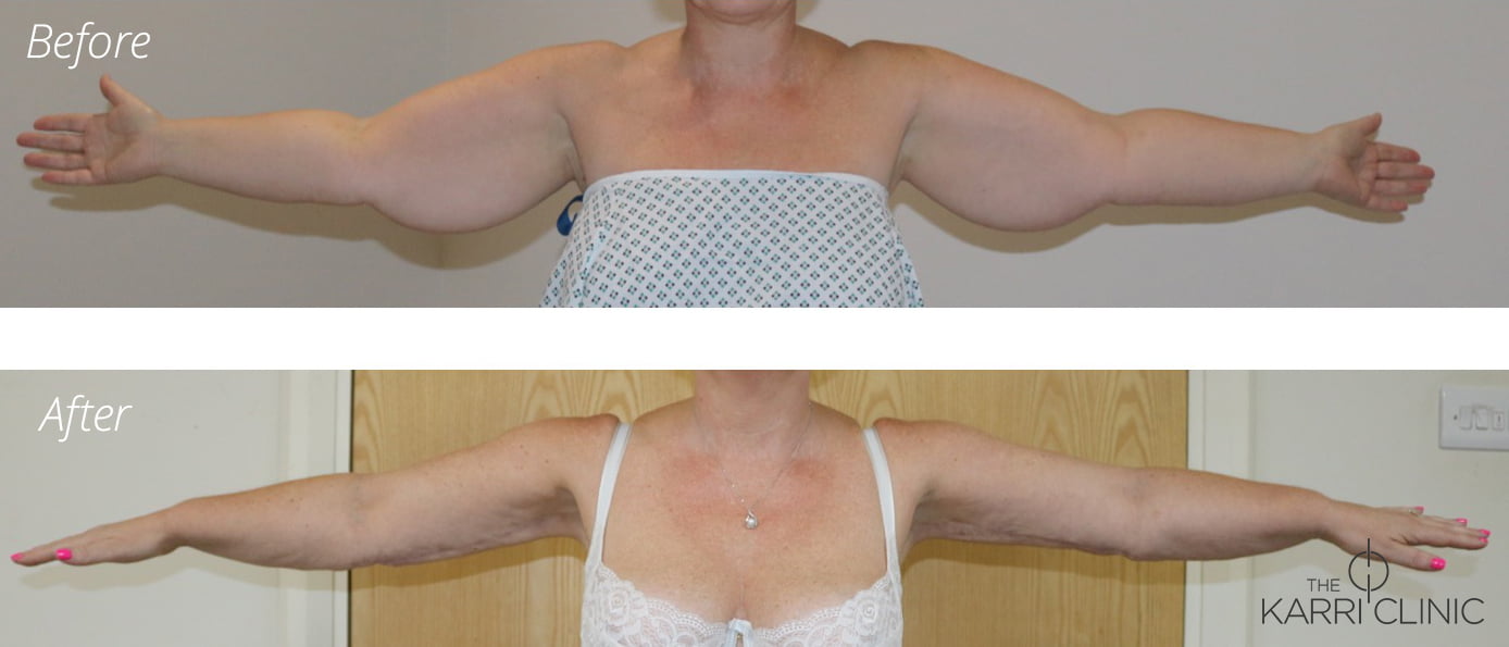 Arm Lift August