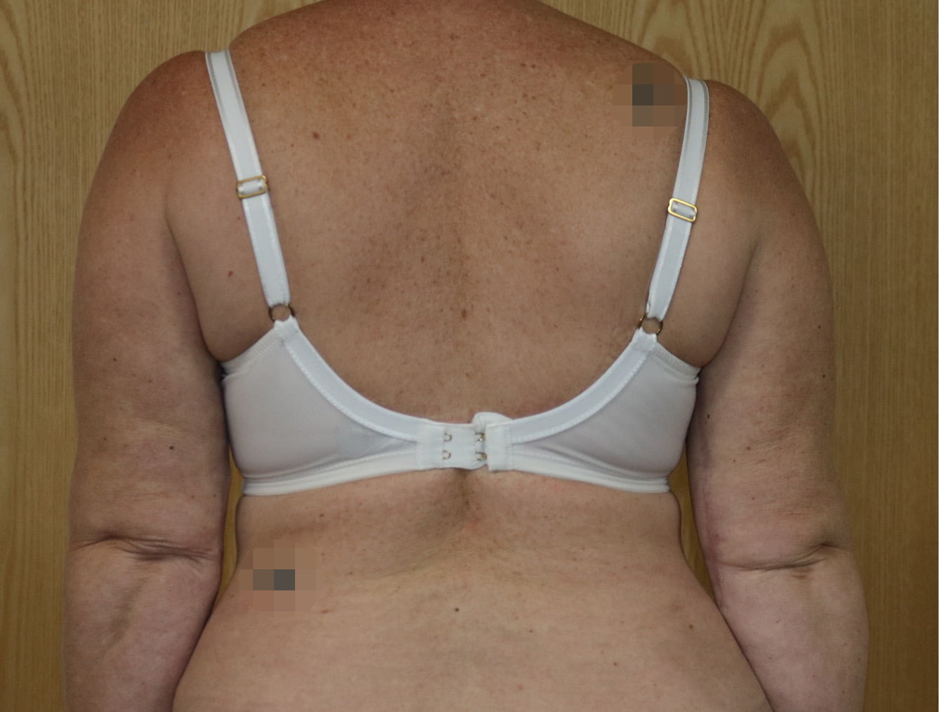 Arm lift brachioplasty scars not readily visible with arms by sides
