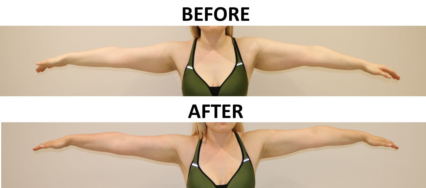 Arm liposuction