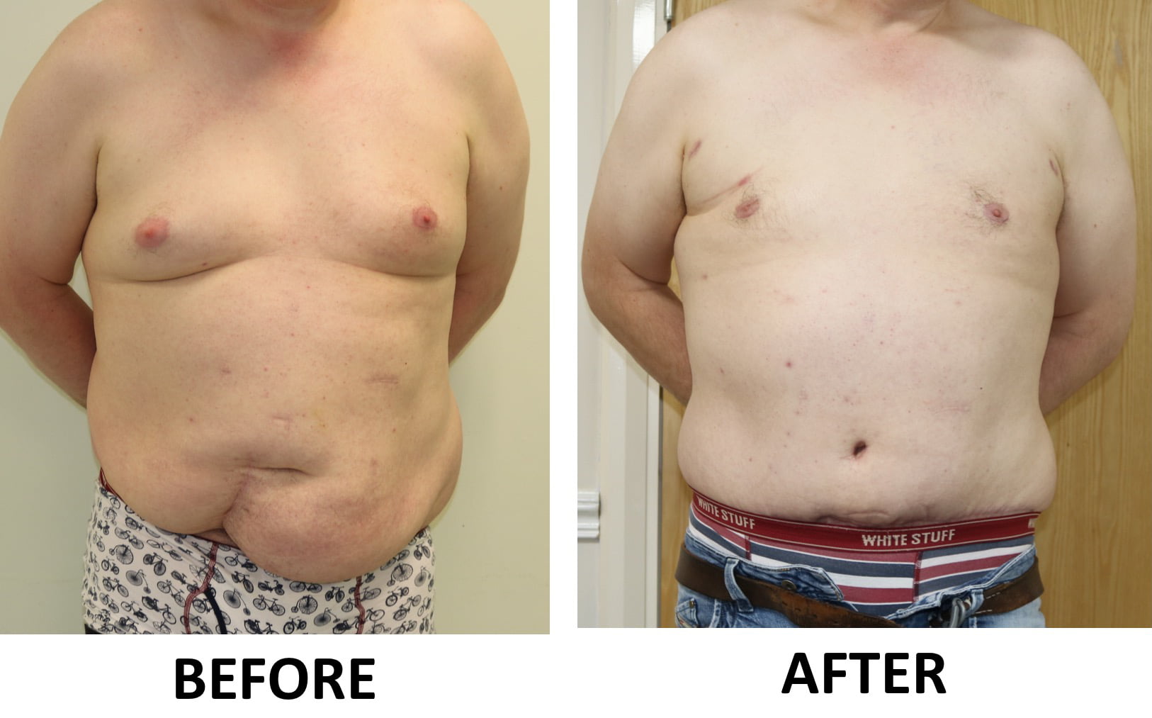 Brazilian tummy tuck gynaecomastia surgery 1