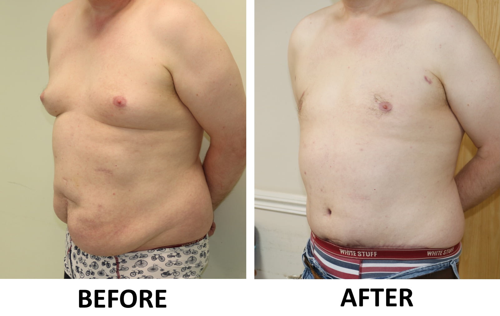 Brazilian tummy tuck gynaecomastia surgery 2