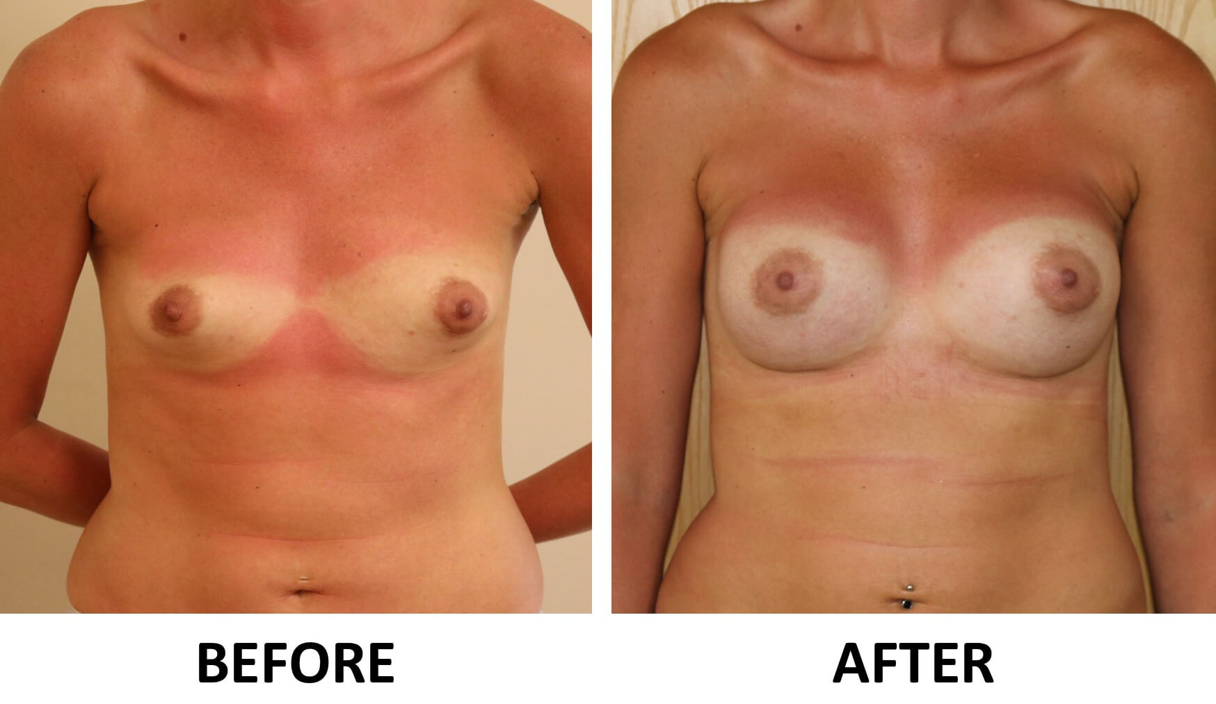 Breast enlargement 1 1
