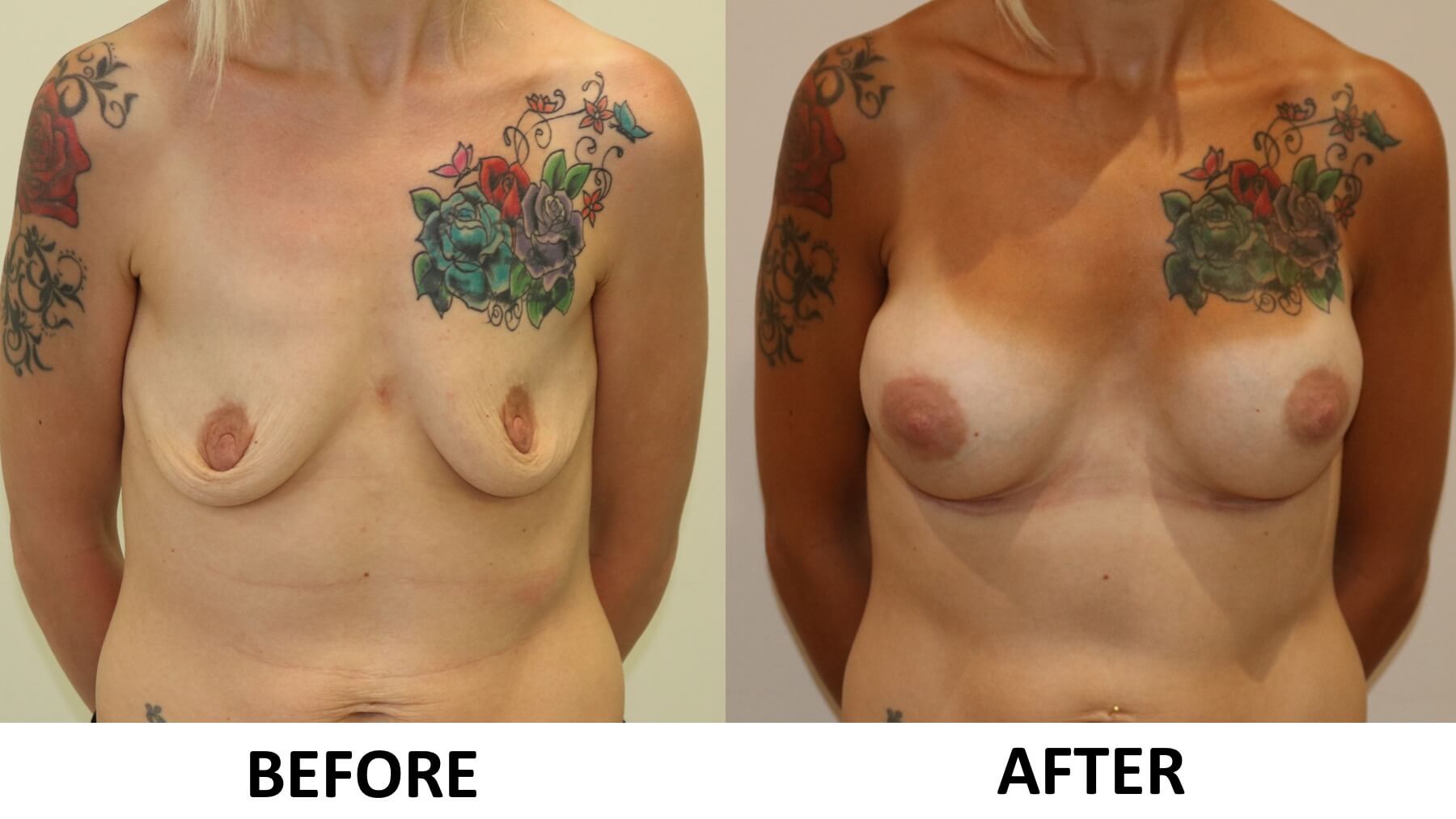 Breast enlargement 1