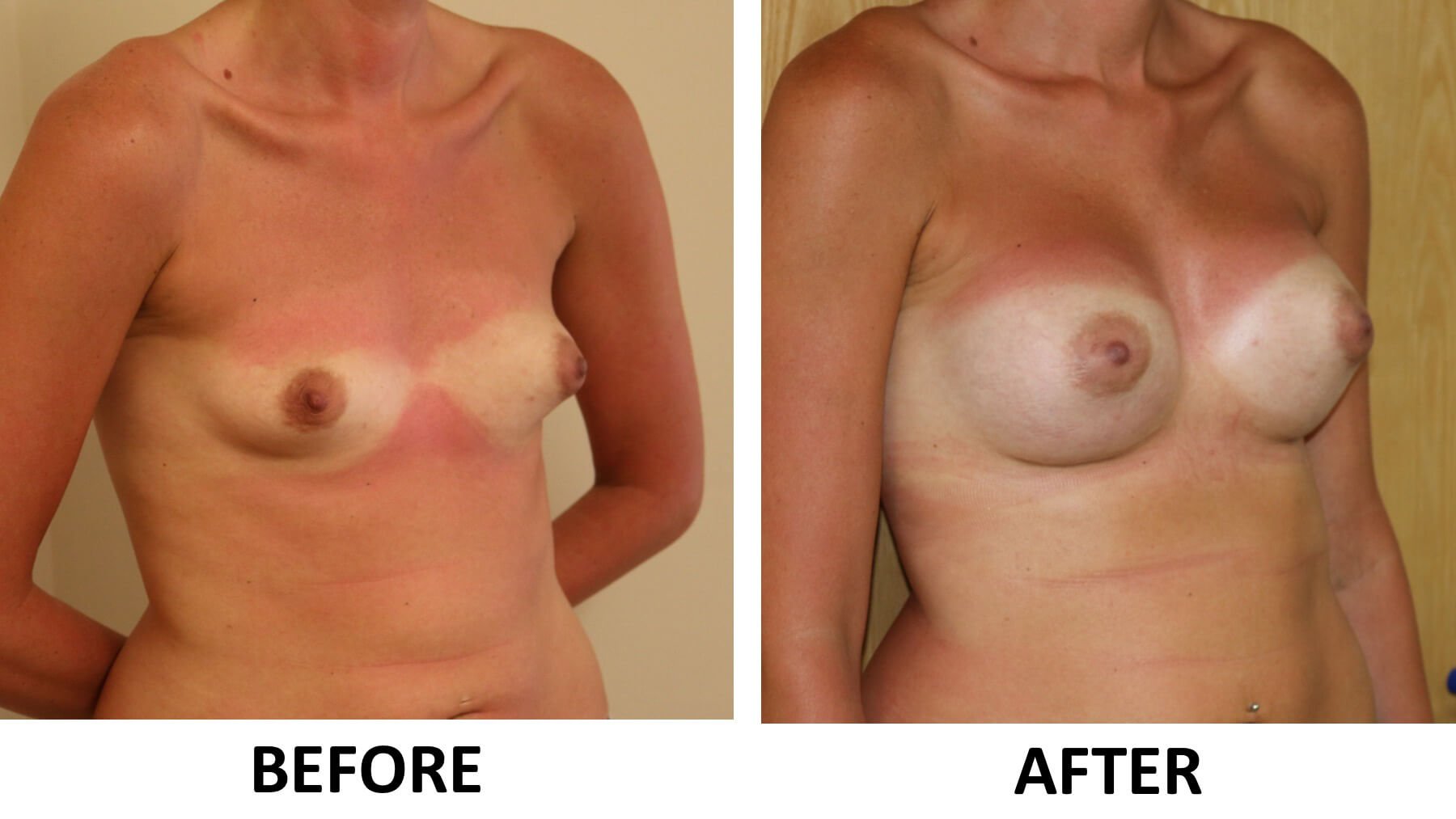 Breast enlargement 2 1