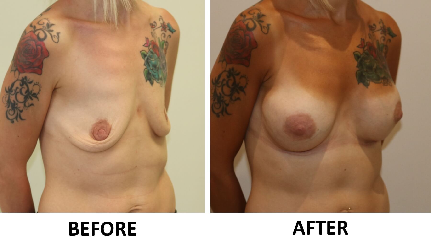 Breast enlargement 2