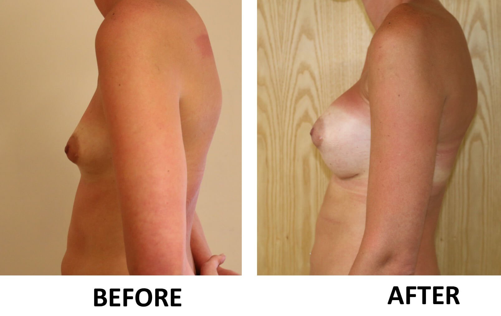 Breast enlargement 3 1