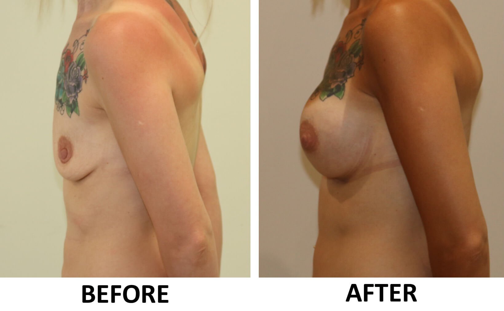 Breast enlargement 3