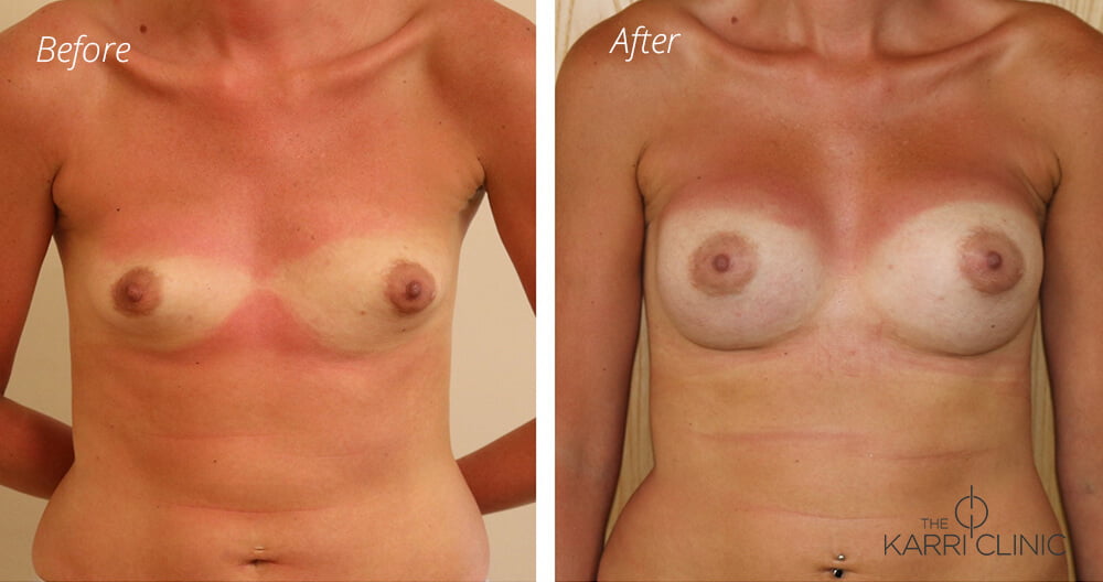 Breast enlargement 1