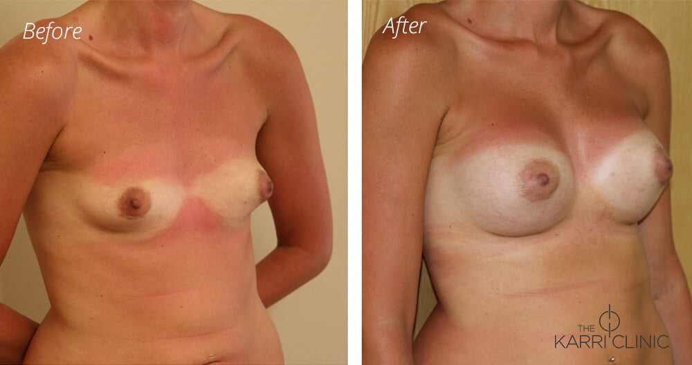 Breast enlargement 2