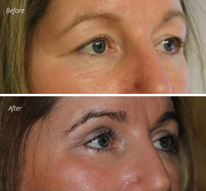 Eye lift and phenol peel