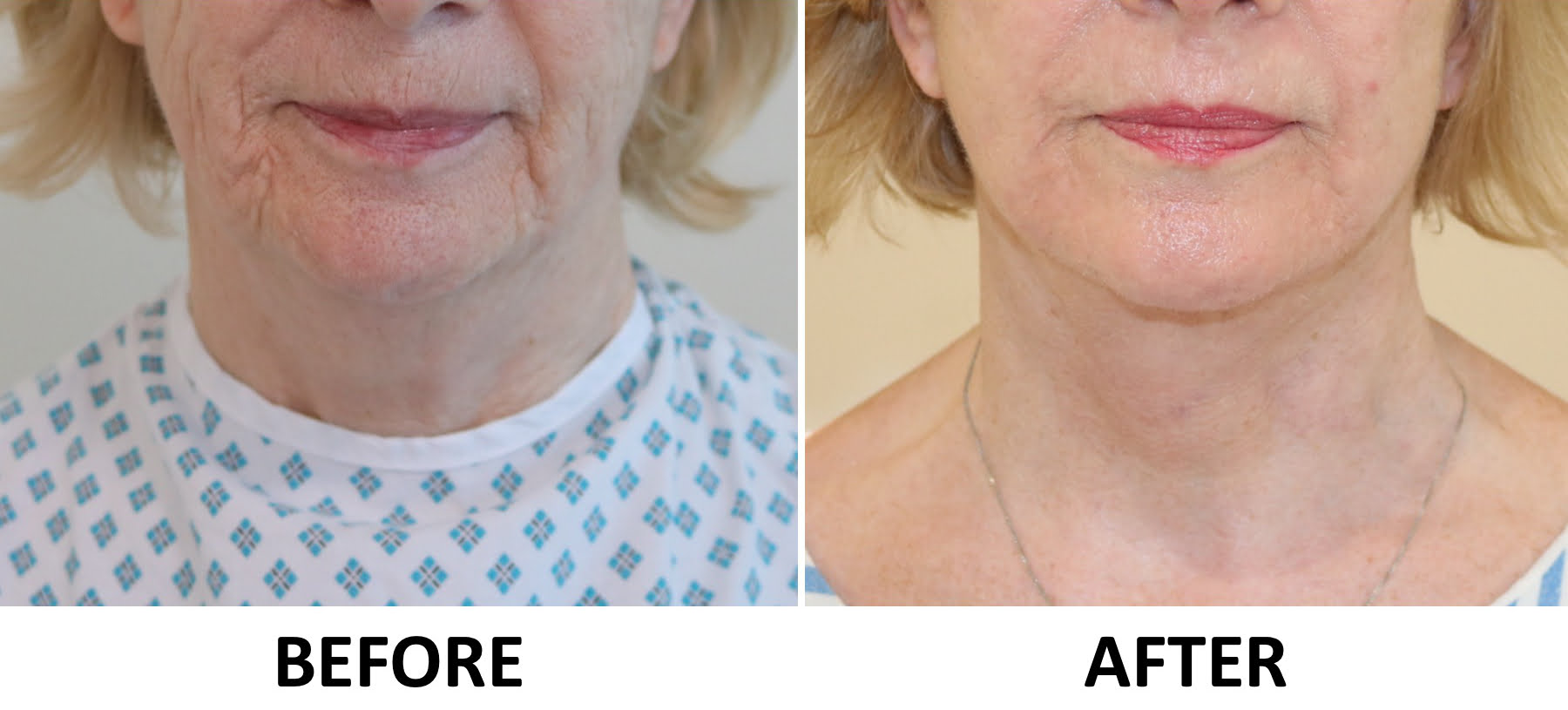 Facelift necklift phenol peel 1