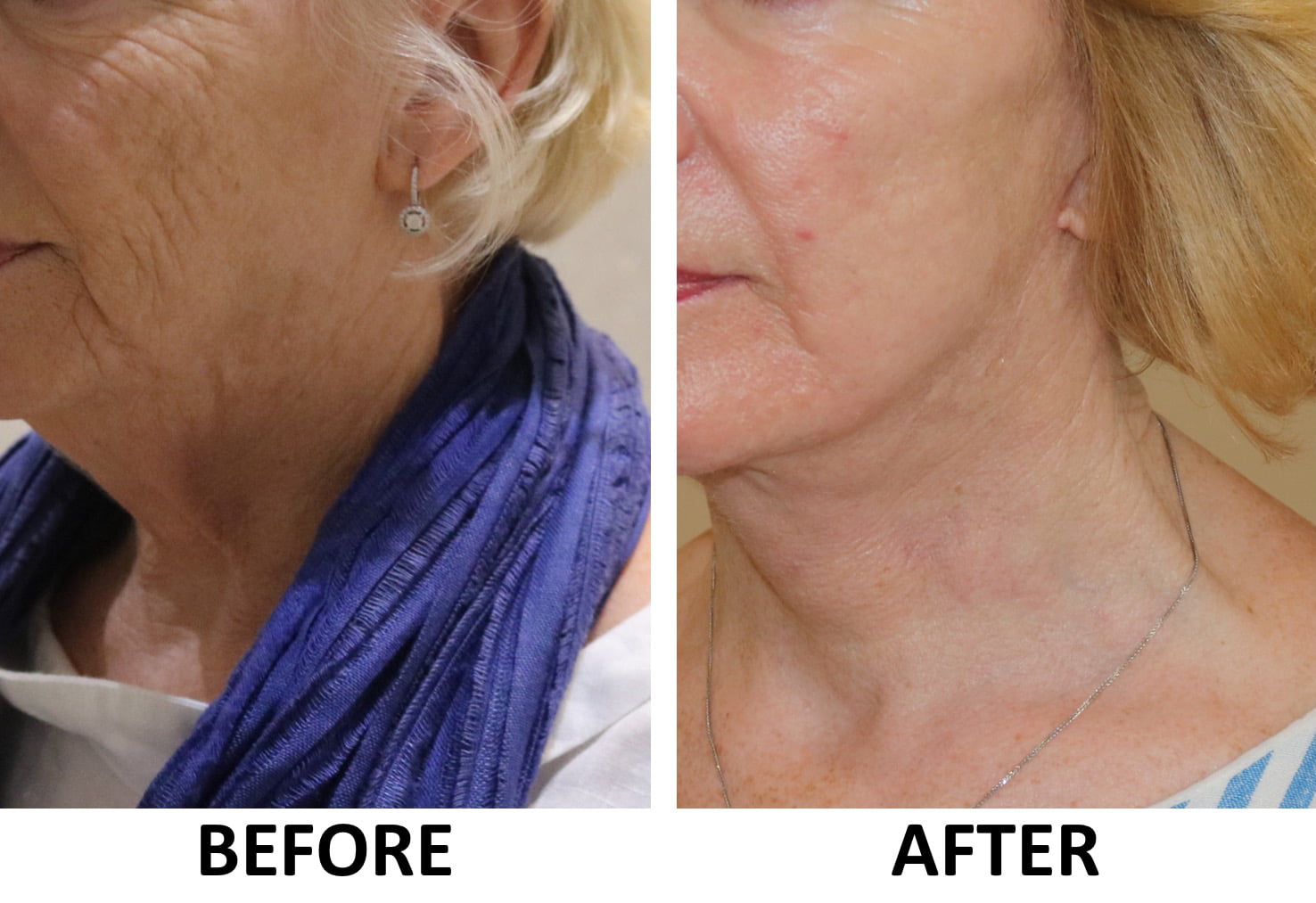 Facelift necklift phenol peel 2