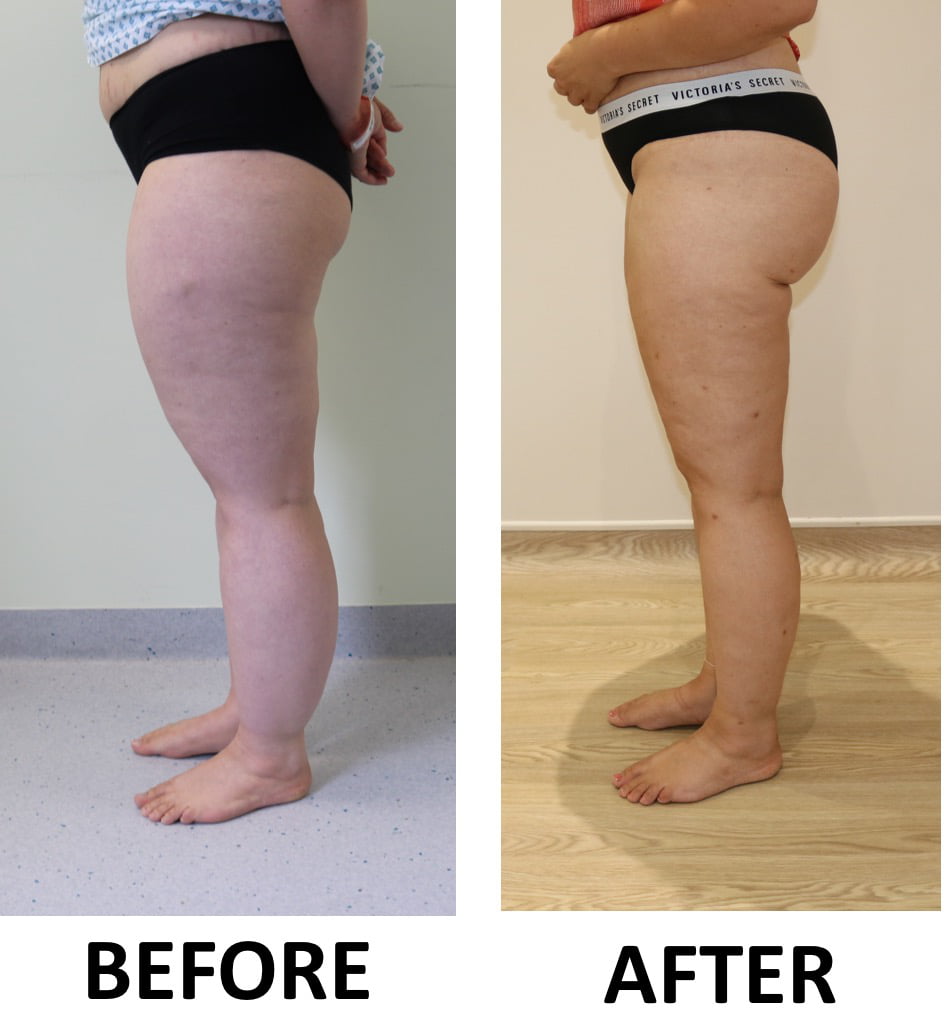 Lipoedema 1
