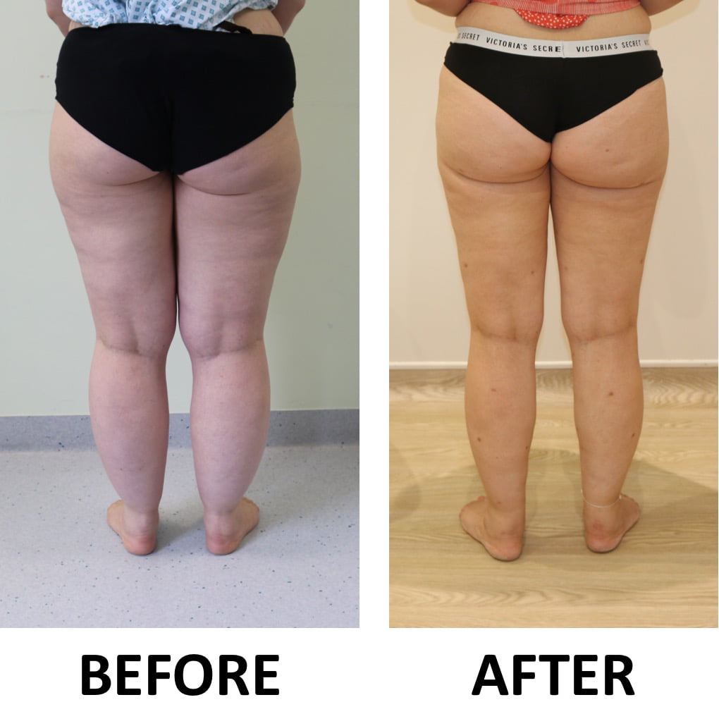 Lipoedema 2