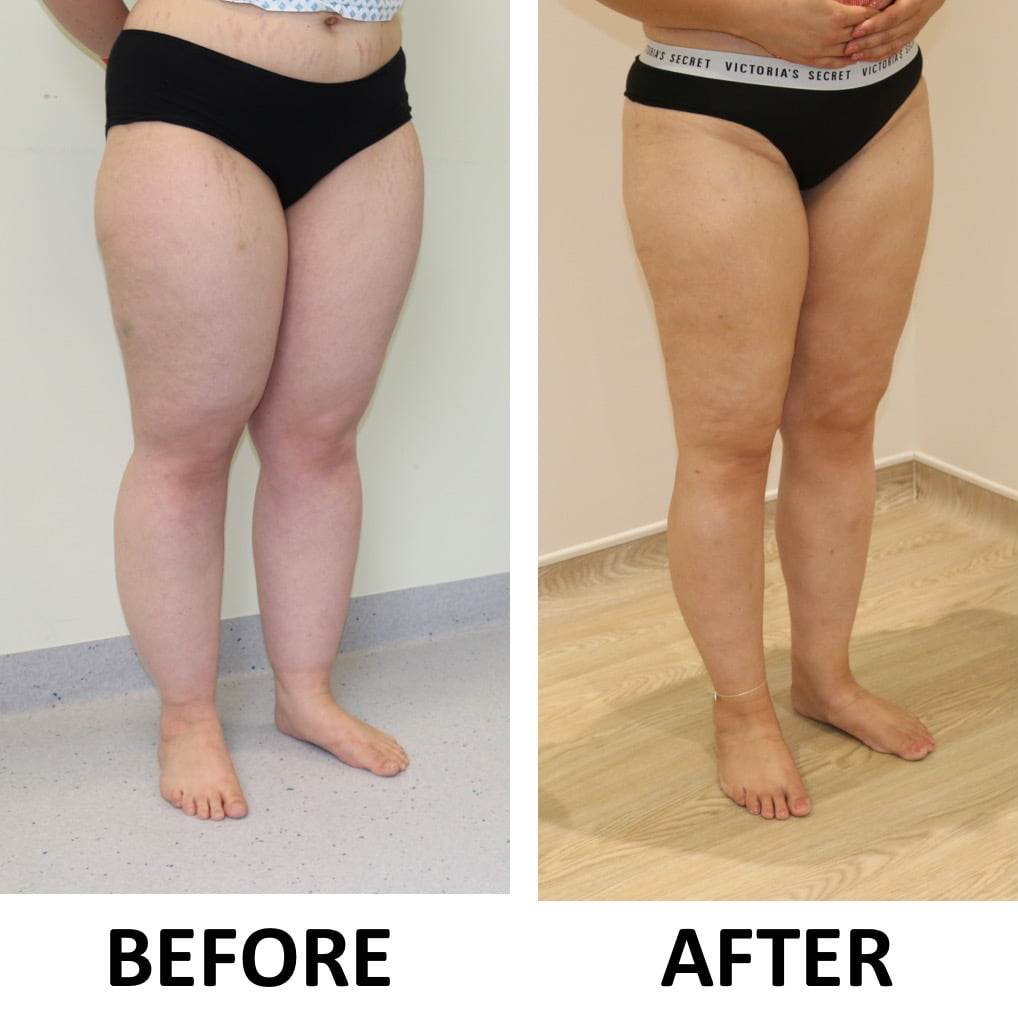 Lipoedema 3