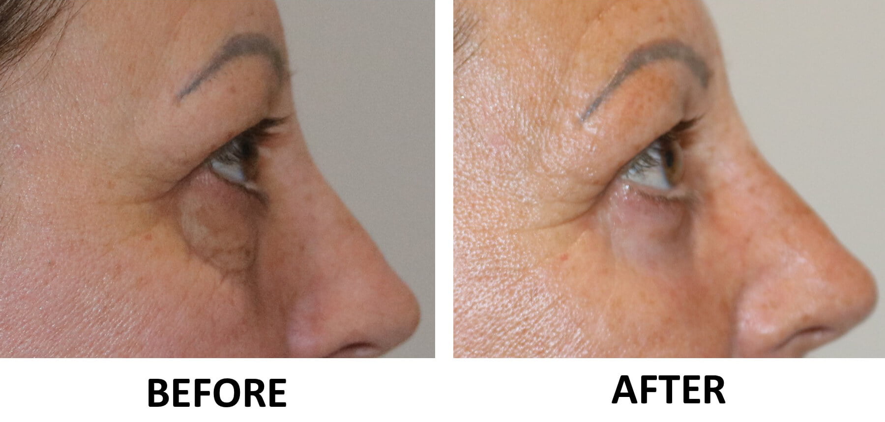 Lower blephs phenol peel 2